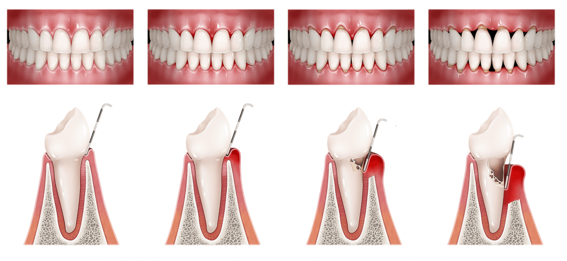 Periodoncia