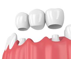 Prótesis dentales fijas sobre dientes naturales