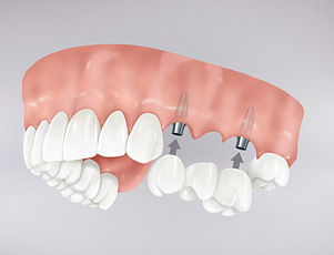 Prótesis dentales fijas sobre implantes: