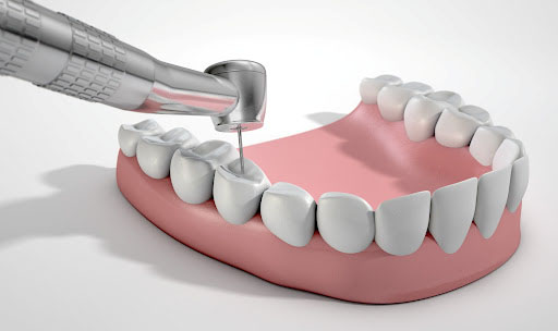 RESTAURACIONES-DENTALES